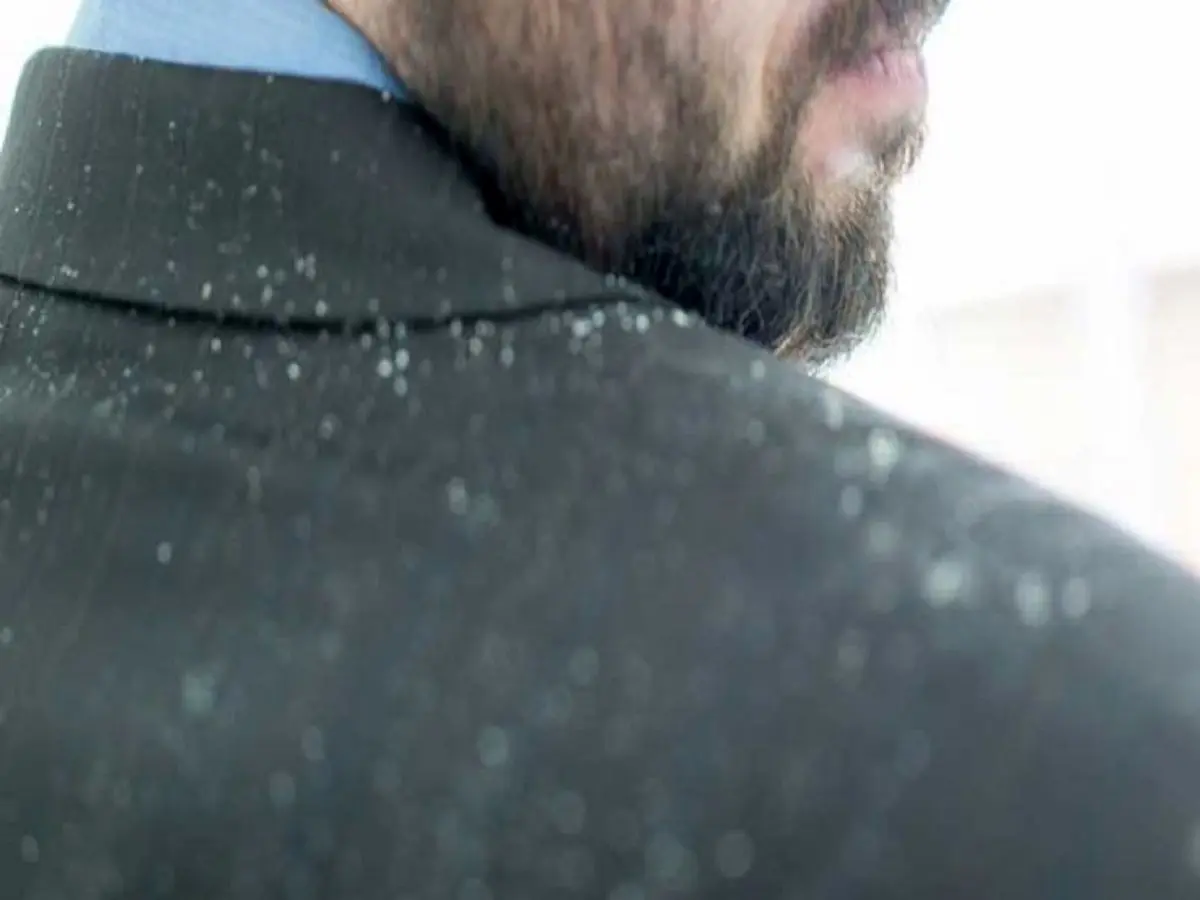 چگونه شوره‌ سر را نابود کنیم؟