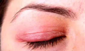 با رایج‌ترین بیماری‌های پلک چشم آشنا شوید