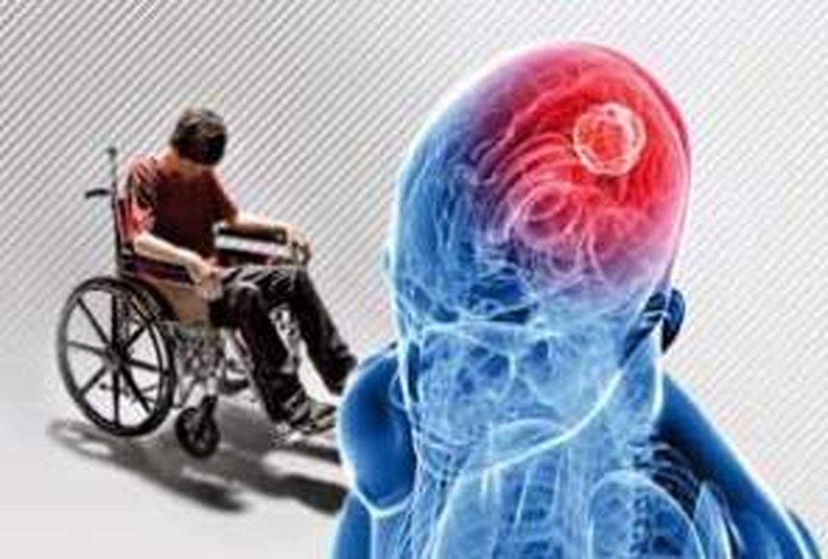 اماس، ۵ سال قبل از حملهاش این علامتها را از خود نشان میدهد