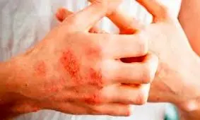 ضدعفونی‌های الکلی باعث اگزما می‌شوند؟