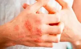 ضدعفونی‌های الکلی باعث اگزما می‌شوند؟