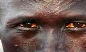 تکذیب خبر انتشار ویروس مرگبار در اتیوپی