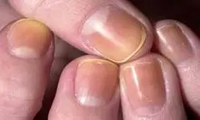 تغییر رنگ ناخن‌ها را جدی بگیرید!