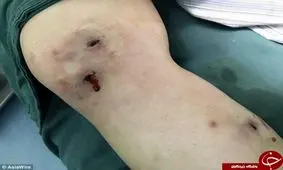 این دختر مگس زنده زیر پوست خود دارد! + تصاویر