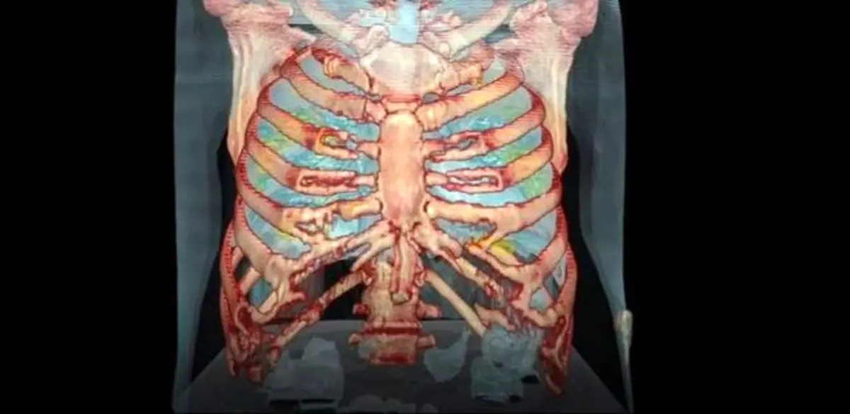 فیلم؛ ریه فرد مبتلا به "کرونا ویروس" اینگونه می‌شود