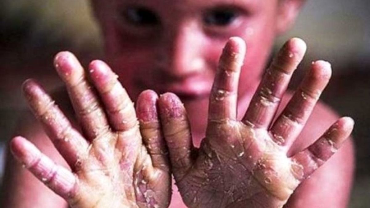 وحشتناکترین بیماری پوستی جهان را بشناسید