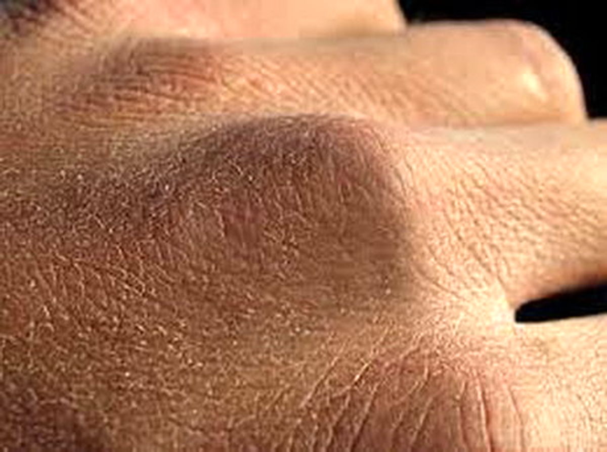 کرونا و خشکی پوست