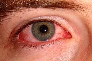 التهاب چشم هم می‌تواند از نشانه‌های تهاجم کرونا باشد