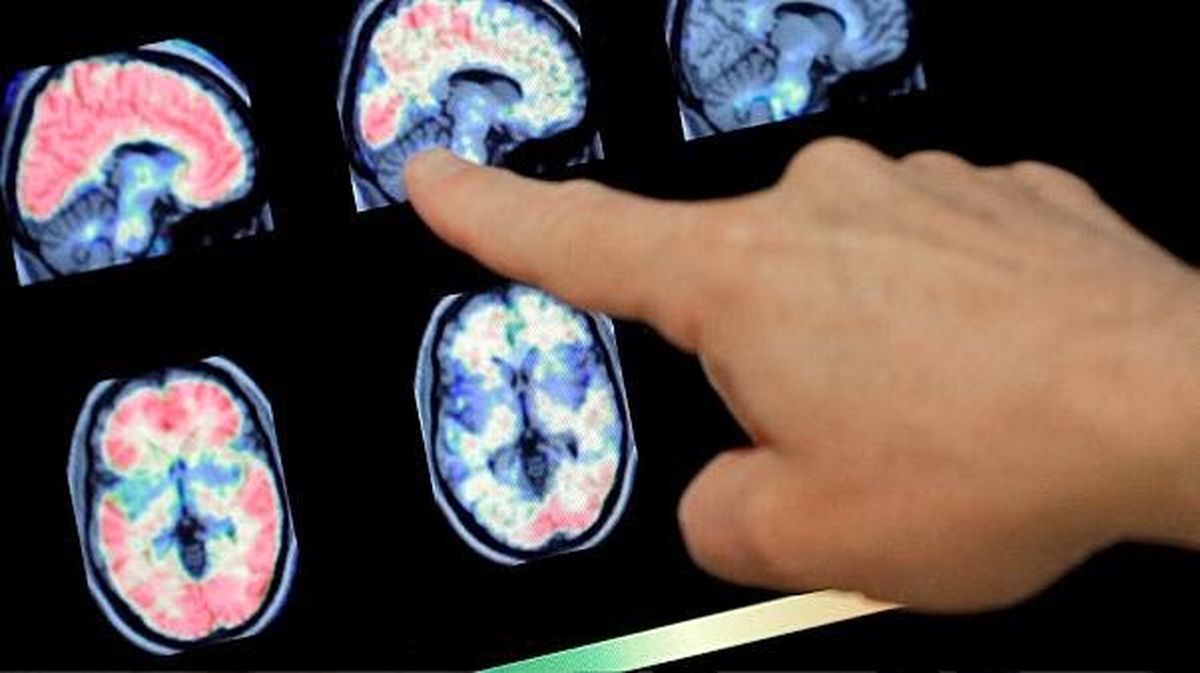 یافته جدید محققان در خصوص تأثیر مخرب ویروس کرونا بر مغز