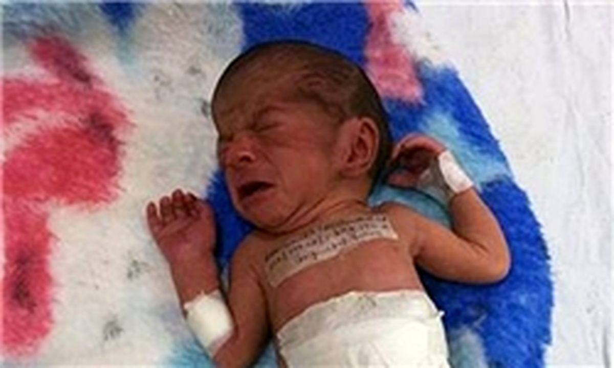 جراحی موفقیت‌آمیز نوزاد دو سر در هندوستان