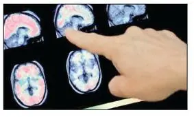 تأثیر کرونا بر مغز