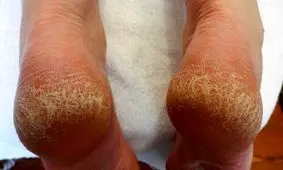 مزایا و معایب پابرهنه راه رفتن