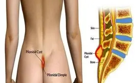 لیزر کیست مویی، صرفه جویی در زمان و هزینه