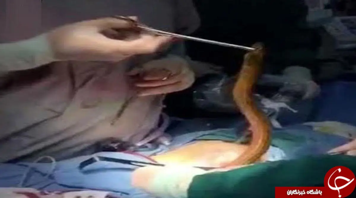 مار زنده ای که از معده انسان خارج شد!