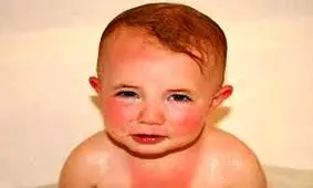 با این ۱۰ ماده آفتاب سوختگی را بهبود بخشید