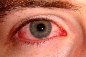 ویروس کرونا می‌تواند باعث درد و قرمزی چشم شود