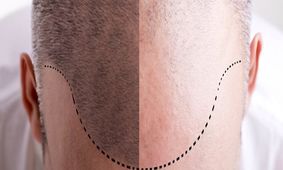 مکانیزم طاسی و سفید شدن مو کشف شد