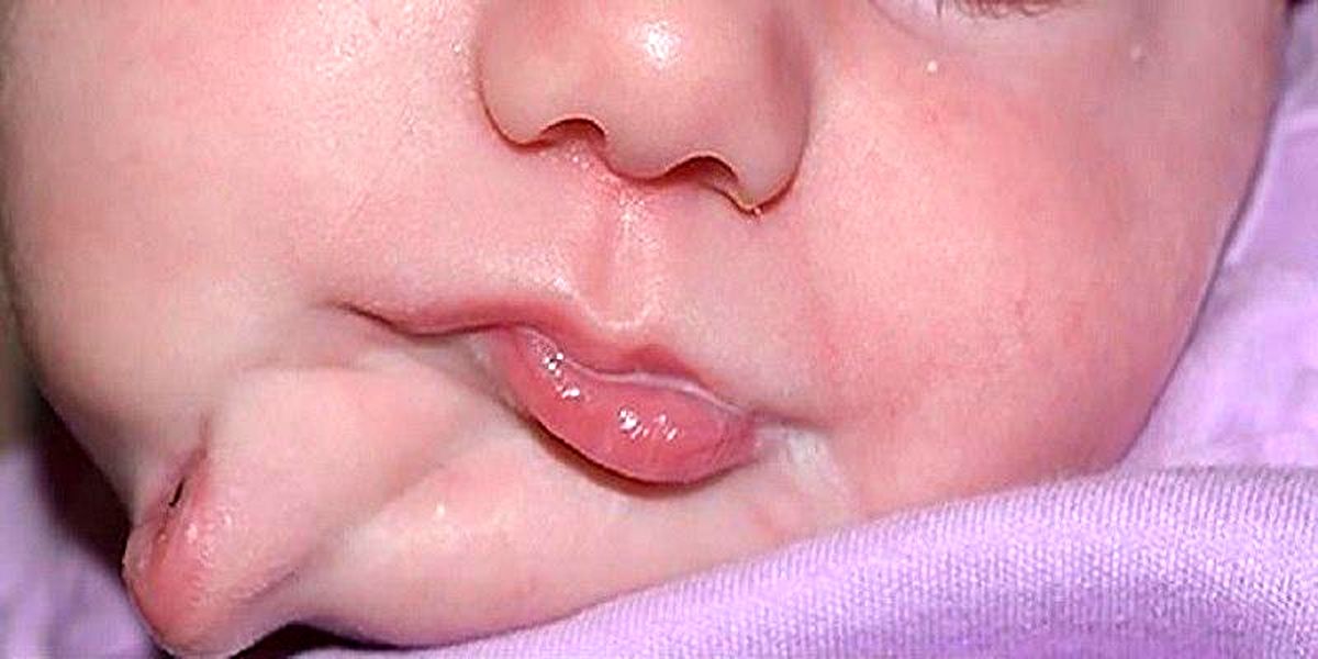 تولد نوزادی با دو دهان در آمریکا + تصاویر