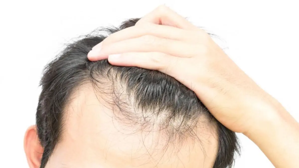 ریزش مو؛ نشانه جدید کرونا!؟