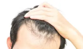 ریزش مو؛ نشانه جدید کرونا!؟