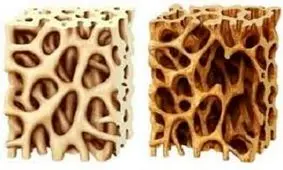 پوکی استخوان بیش‌ترین فایده این غذاهاست!