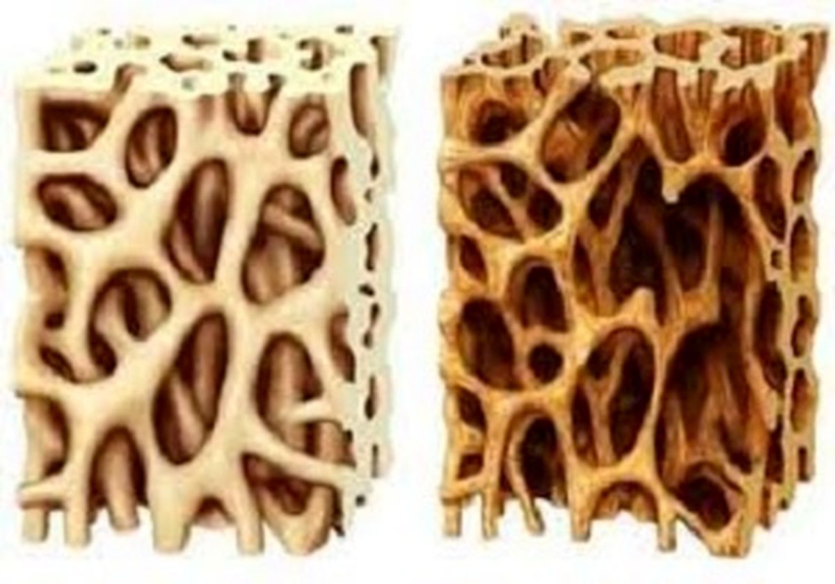 پوکی استخوان بیش‌ترین فایده این غذاهاست!