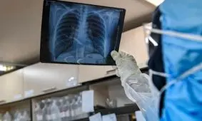 مشکلات تنفسی در بهبود یافتگان کرونا ماندگار است؟