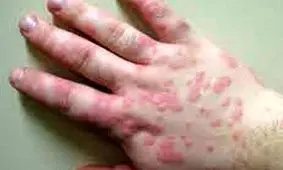 علائم کهیر یا آبله مرغان به همراه تب داشتید به فکر کرونا باشید