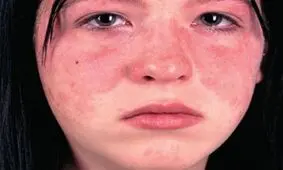 چگونه لوپوس روی چشمان شما اثر می‌گذارد؟