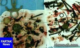 از شکم مرد مشهدی 150 قطعه فلزی خارج شد!