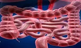 اصلی‌ترین علایم سرطان روده چیست؟