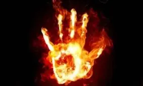 دختر ۱۸ ساله رشتی در آتش خشم و تعصب برادر سوخت