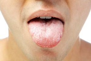 رایج‌ترین علل خشکی دهان را بشناسید