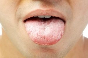 رایج‌ترین علل خشکی دهان را بشناسید