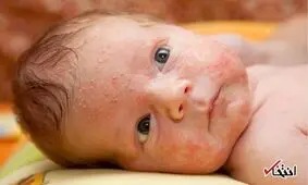 چگونه آفتاب سوختگی پوست را به سرعت درمان کنیم؟