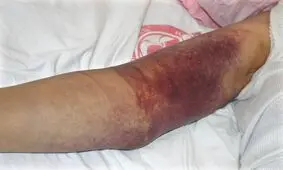 موردی از بیماری تب کریمه کنگو در آذربایجان غربی دیده نشده است