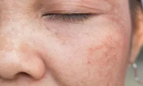 جوش های صورتتان را با این روشها یک شبه از بین ببرید