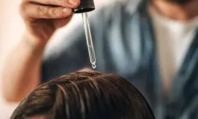 شوره سر چیست و چگونه درمان می شود؟