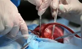 افزایش ۲۰ درصدی پیوند کبد در کشور