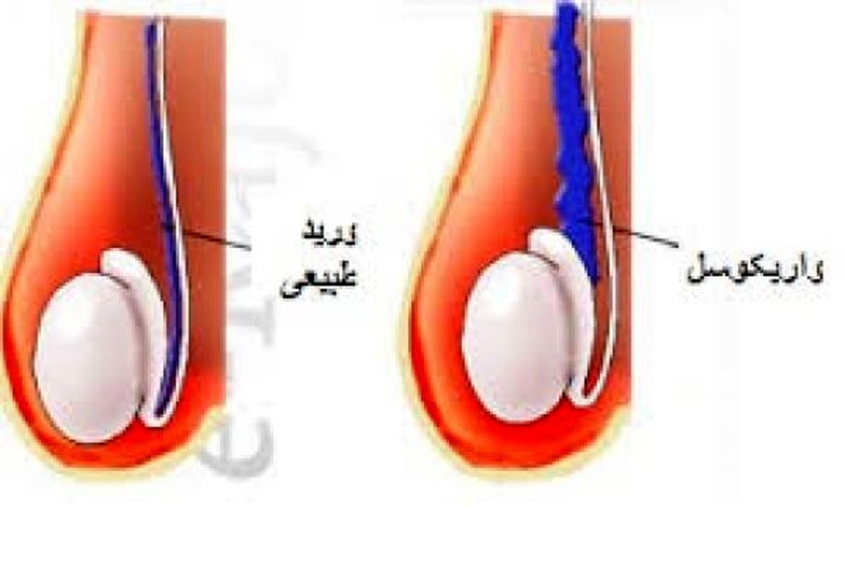 از واریکوسل چه میدانید؟