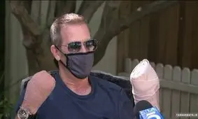 قطع دستان یک مرد به دلیل کرونا