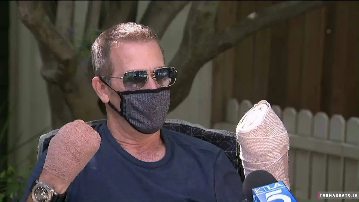 قطع دستان یک مرد به دلیل کرونا