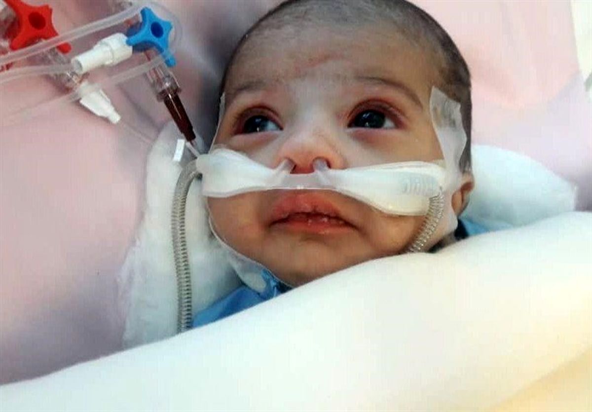 عمل قلب باز کودک ۲۶ روزه در مشهد با موفقیت انجام شد