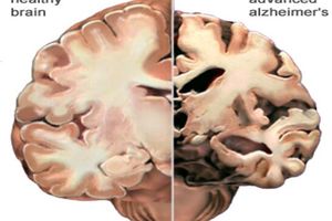 عوامل موثر در کاهش خطر آلزایمر