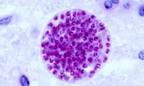 ۲ میلیارد نفر انگل مغزی دارند؛ اما چرا متوجه نمی‌شوند؟