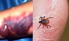 علایم تب کریمه کنگو