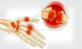 کاهش ورم مفاصل روماتیسم با فناوری نانو