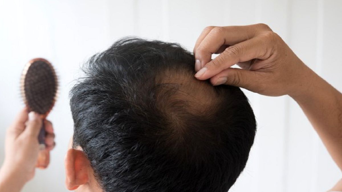۶ علت اصلی ریزش مو