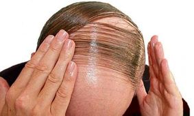 روش جدید برای از بین بردن ریزش مو ابداع شد