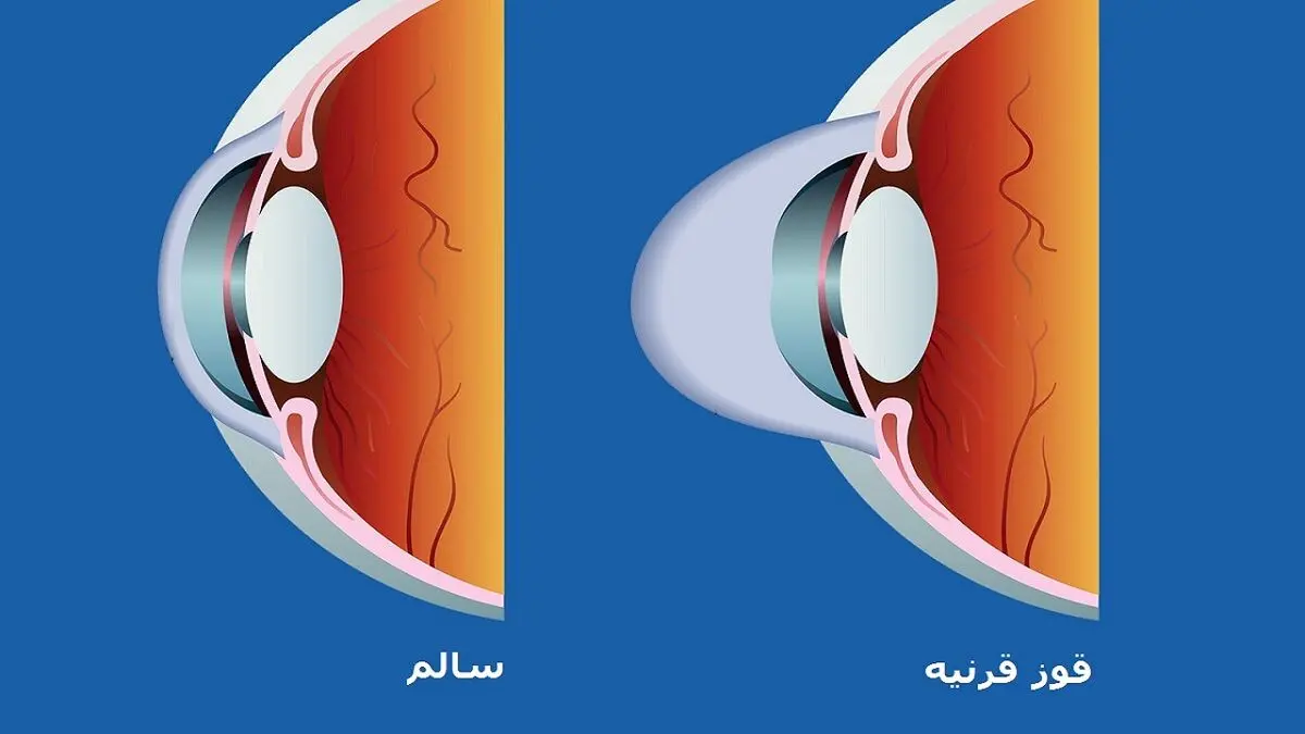 قوز قرنیه را با آستیگمات اشتباه نگیریم